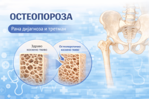 Анатомска илустрација на остеопороза со споредба помеѓу здраво и остеопоротично коскено ткиво